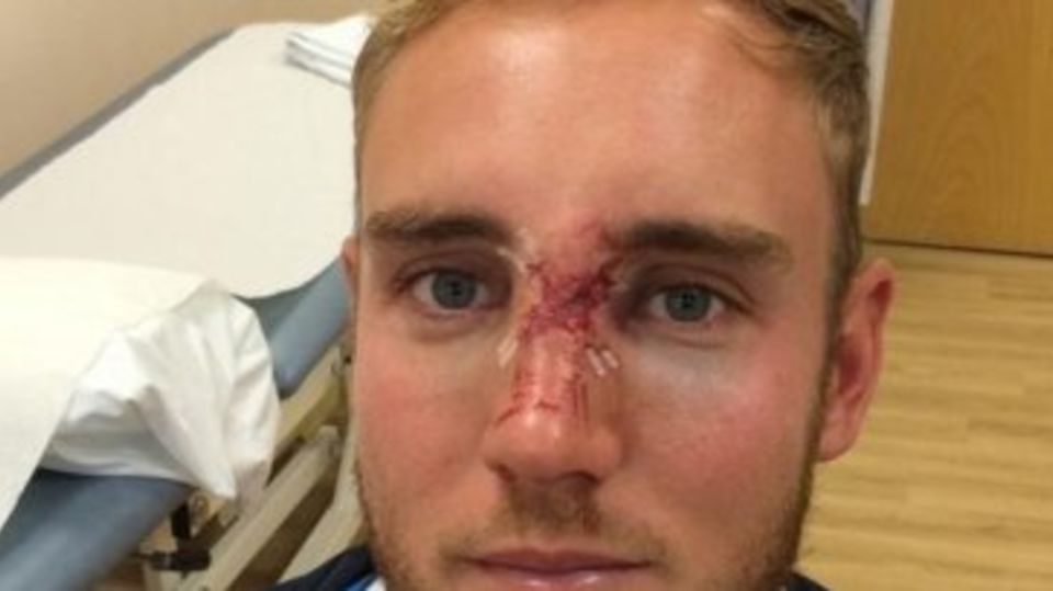 Stuart Broad shows the results of his blow in the face