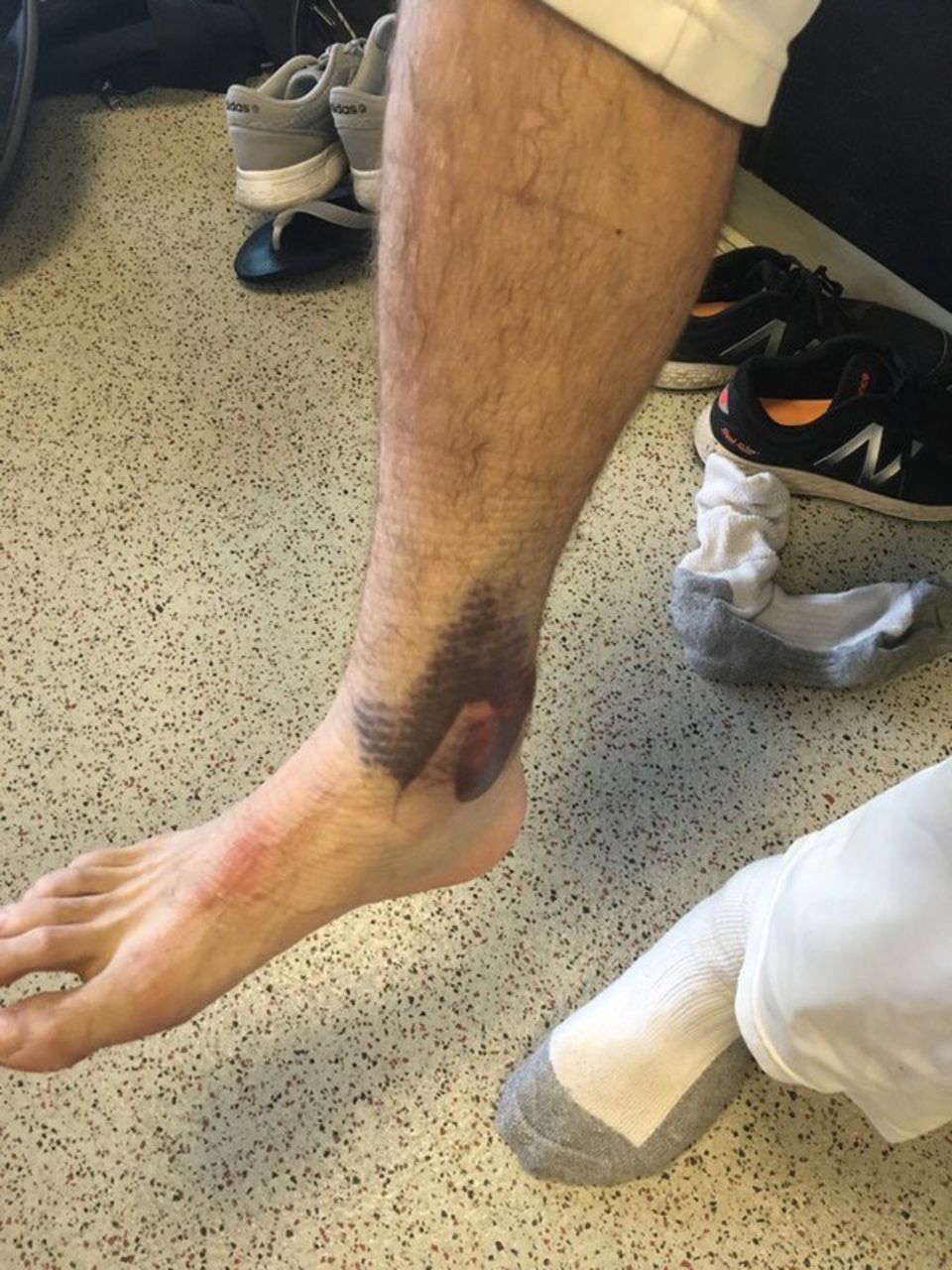 A close-up of Hildreth's bruised ankle