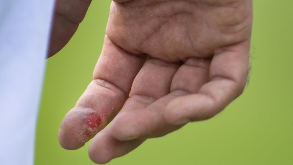 Moeen Ali suffered a blister on the index finger of his right hand