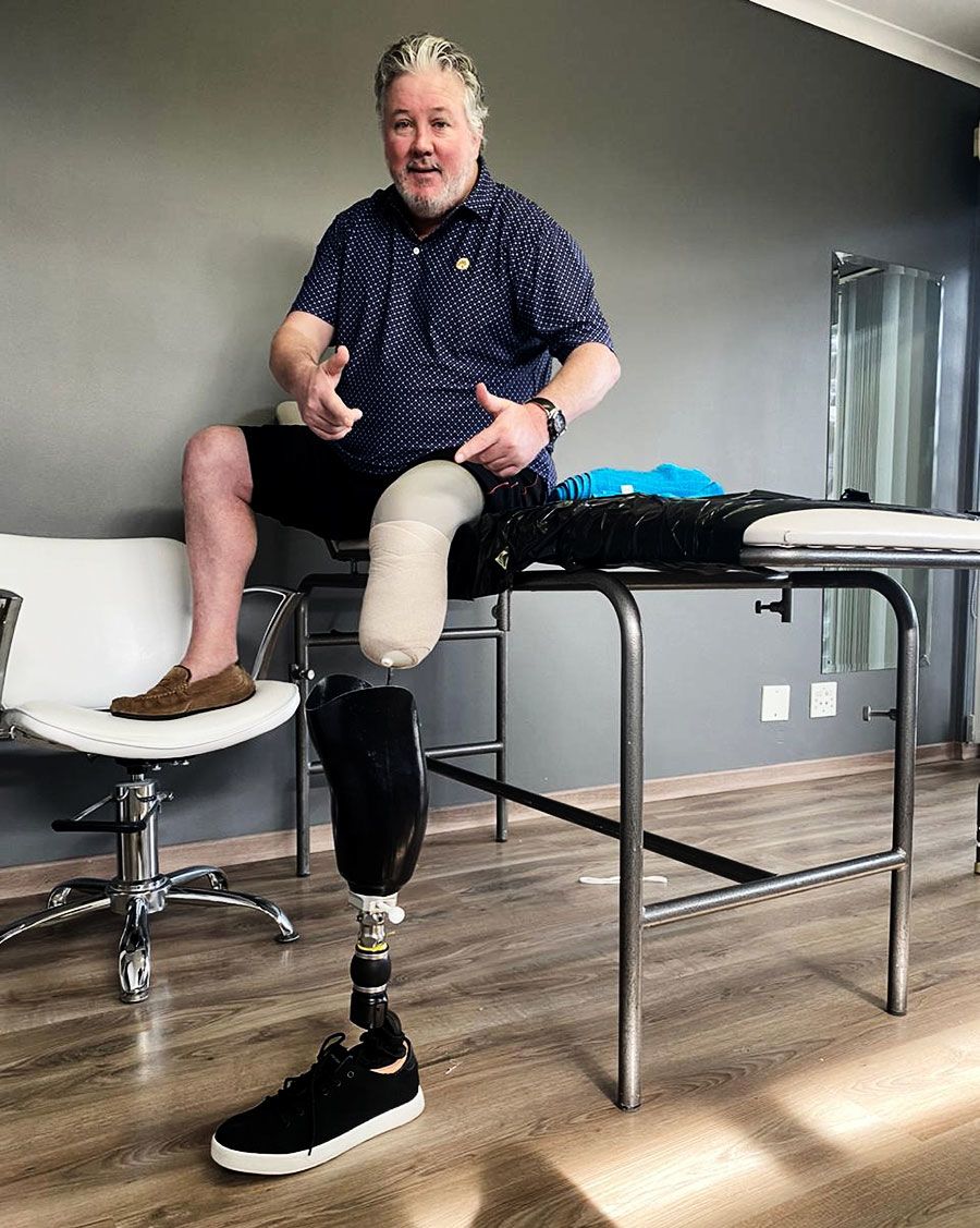 Andy Moles with his prosthetic leg