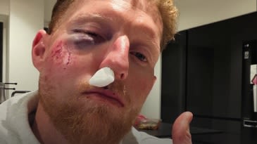 Ben Stokes undergoes surgery after blow to face in nets